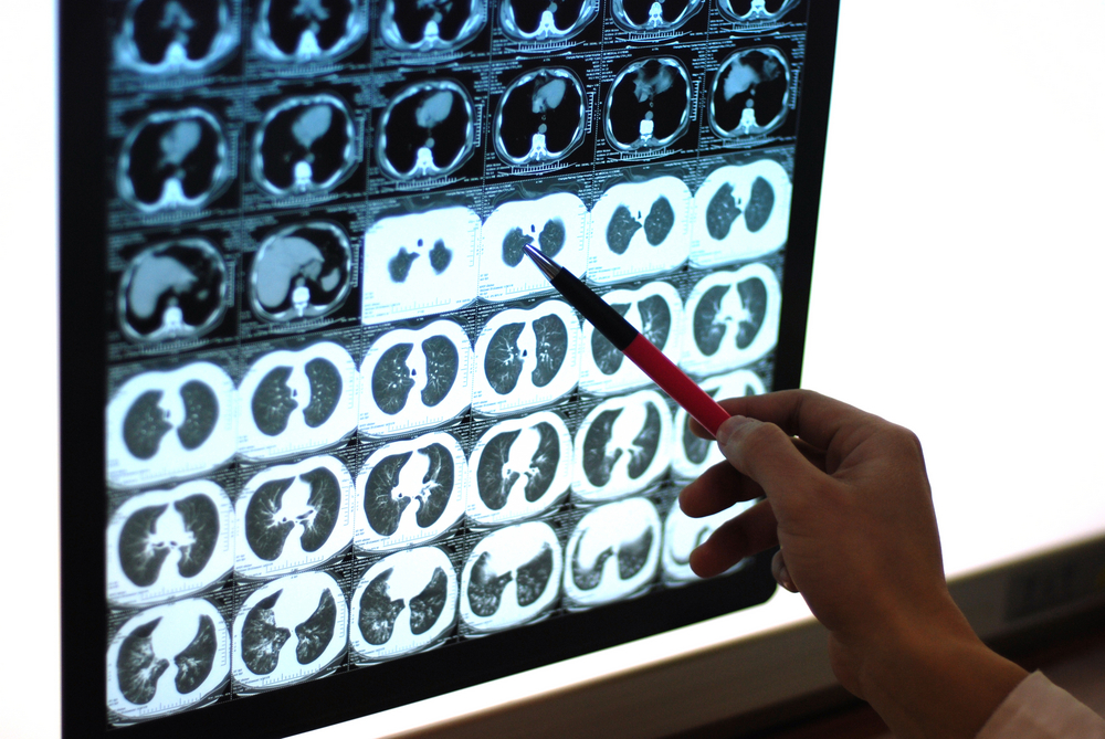 Bronchiectasis cancer